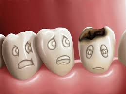 Bệnh sâu răng do nguyên nhân nào và cách phòng tránh ra sao? 1