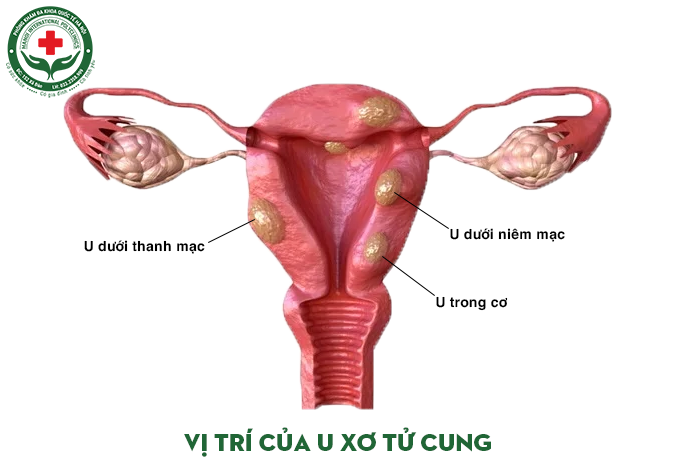 Hình ảnh và vị trí của u xơ tử cung