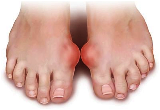 Bệnh Gout do nguyên nhân nào gây nên? 1
