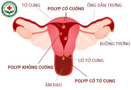 Bệnh polyp cổ tử cung là gì
