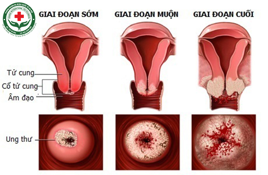các giai đoạn của bệnh viêm lộ tuyến cổ tử cung