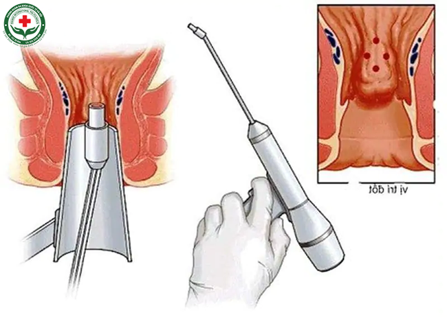 Chữa viêm lộ tuyến cổ tử cung bằng phương pháp đốt điện